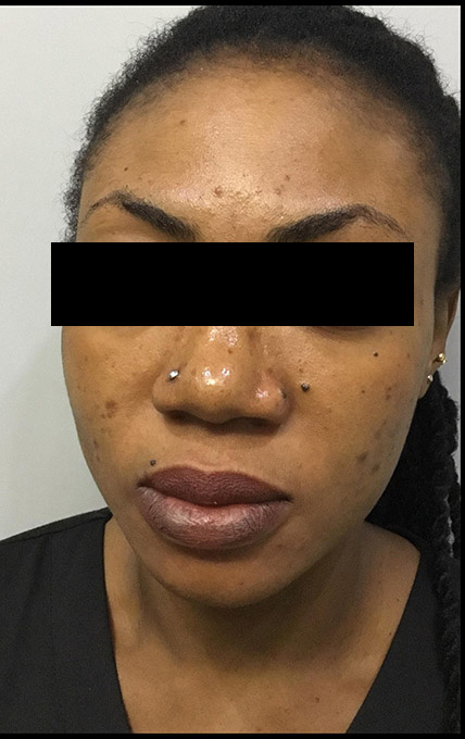 Microneedling With Prp Before and After | Flawless Aesthetic Center