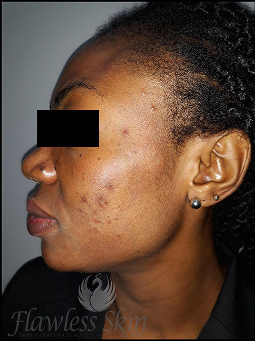 Microneedling With Prp Before and After | Flawless Aesthetic Center