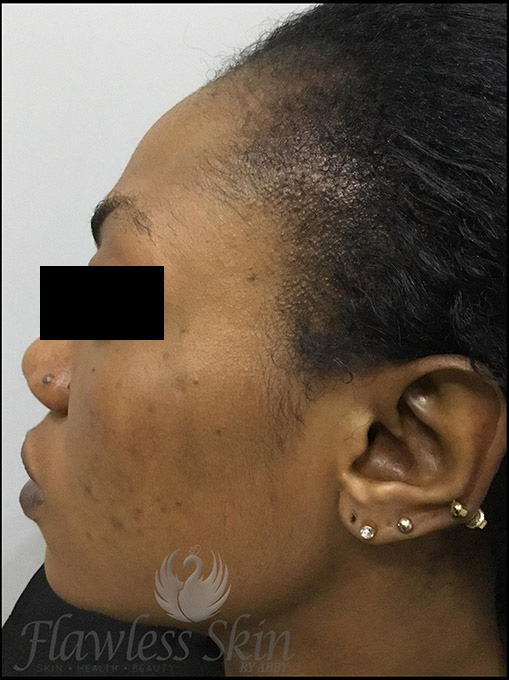 Microneedling With Prp Before and After | Flawless Aesthetic Center