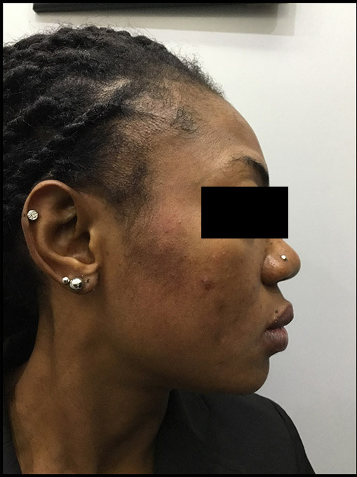 Microneedling With Prp Before and After | Flawless Aesthetic Center