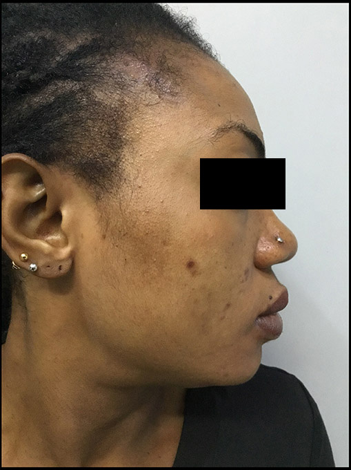 Microneedling With Prp Before and After | Flawless Aesthetic Center