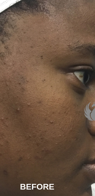Microneedling With Prp Before and After | Flawless Aesthetic Center