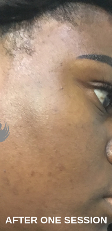 Microneedling With Prp Before and After | Flawless Aesthetic Center
