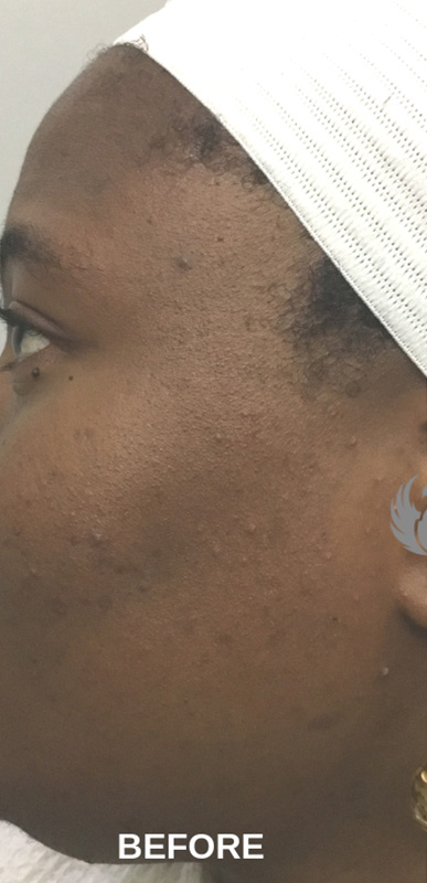 Microneedling With Prp Before and After | Flawless Aesthetic Center
