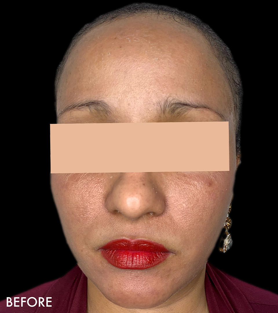 Microneedling With Prp Before and After | Flawless Aesthetic Center