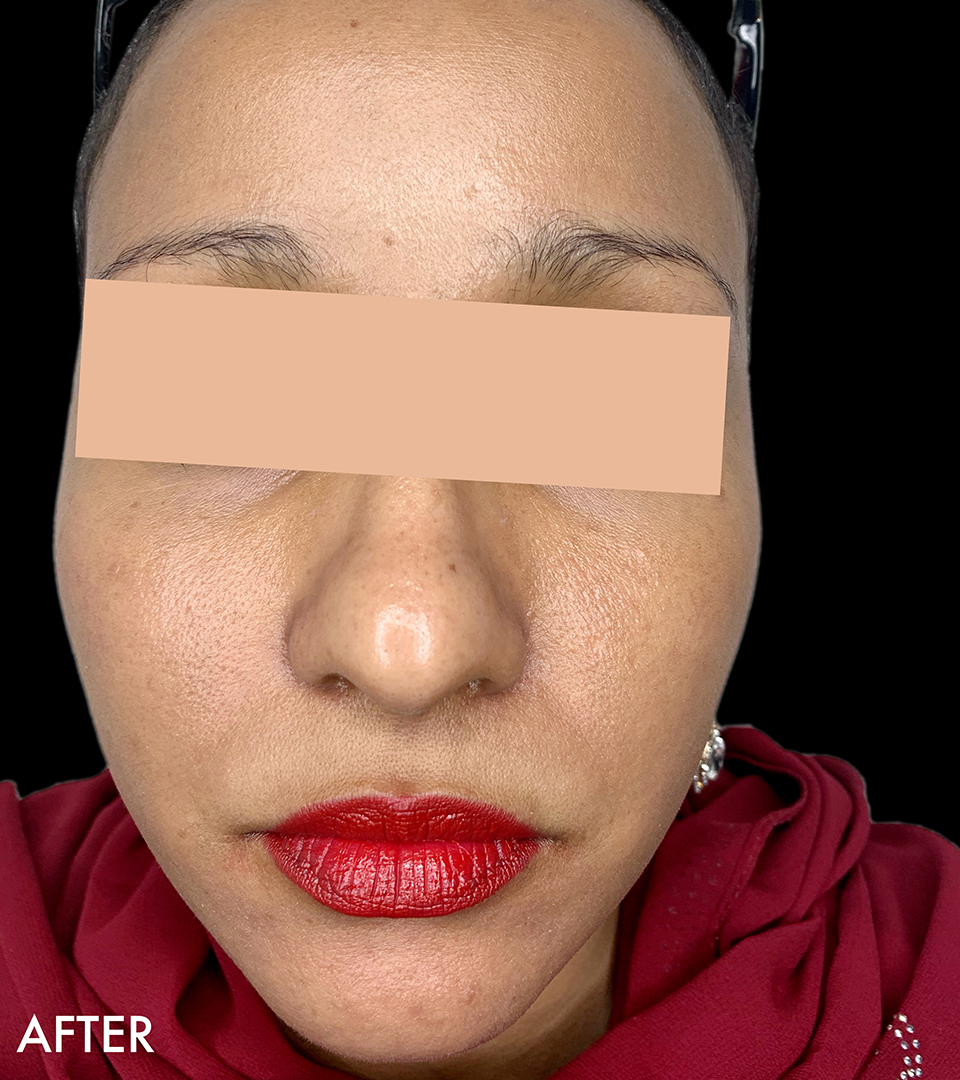 Microneedling With Prp Before and After | Flawless Aesthetic Center