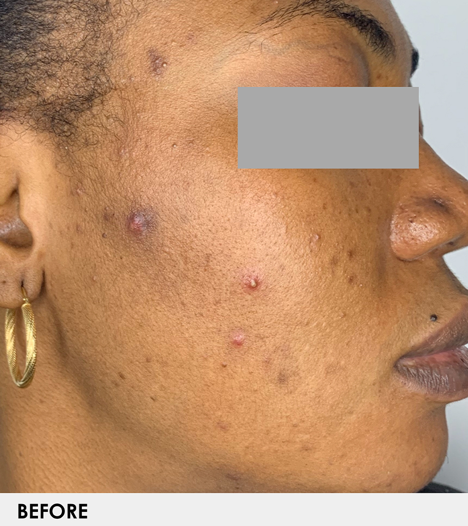 Microneedling With Prp Before and After | Flawless Aesthetic Center