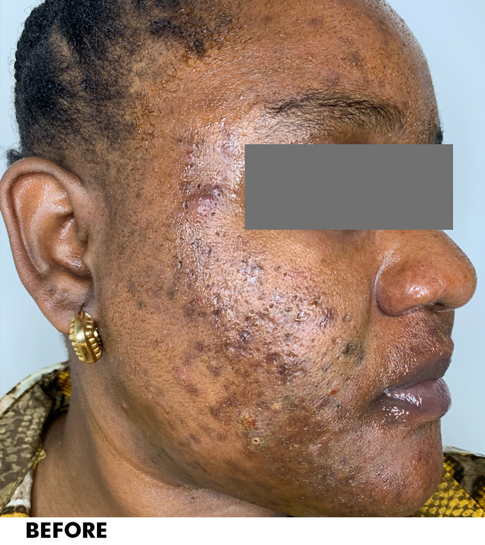 Microneedling With Prp Before and After | Flawless Aesthetic Center