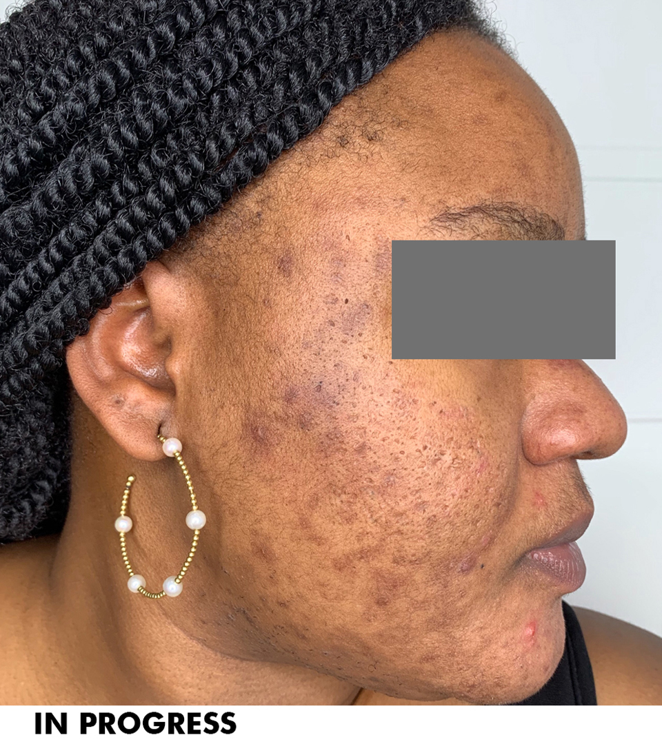 Microneedling With Prp Before and After | Flawless Aesthetic Center