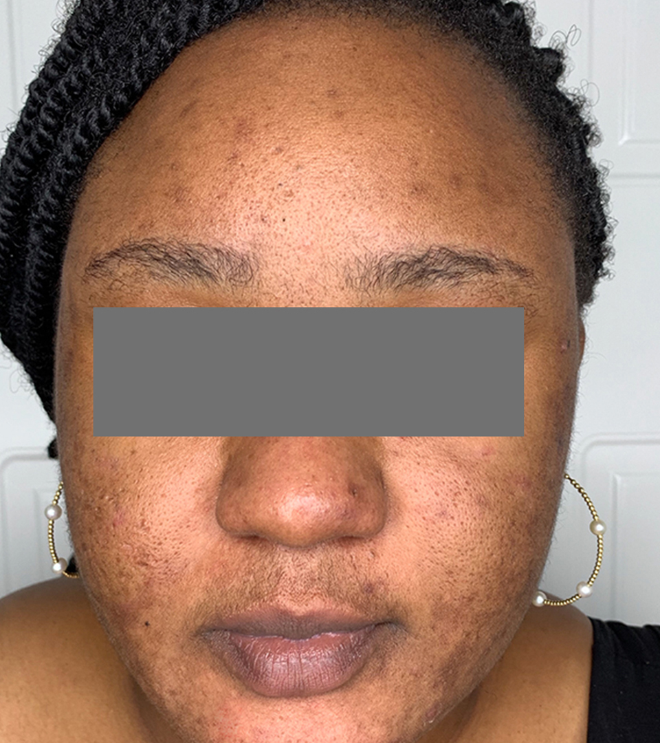 Microneedling With Prp Before and After | Flawless Aesthetic Center