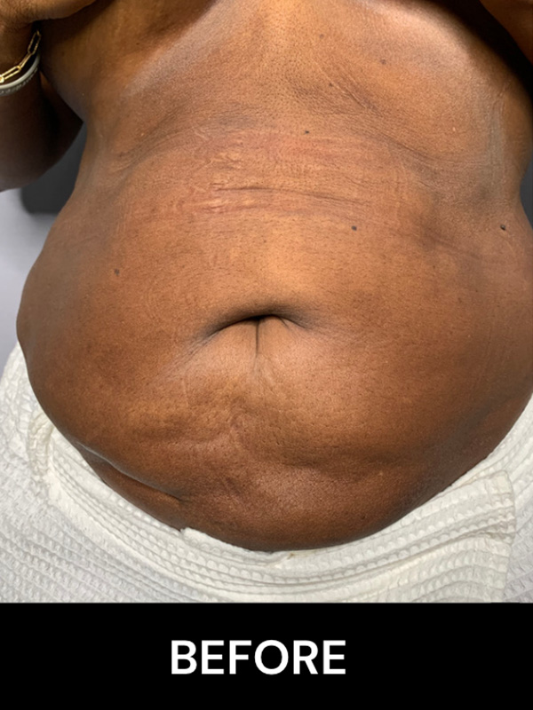 Morpheus8 Before and After | Flawless Aesthetic Center