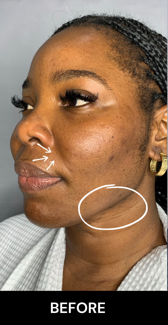 Morpheus8 Before and After | Flawless Aesthetic Center