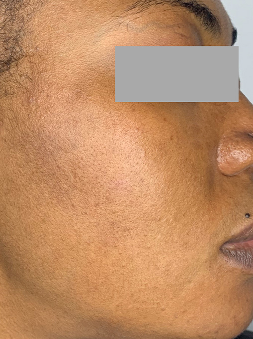 Skin Resurgacing Before and After | Flawless Aesthetic Center