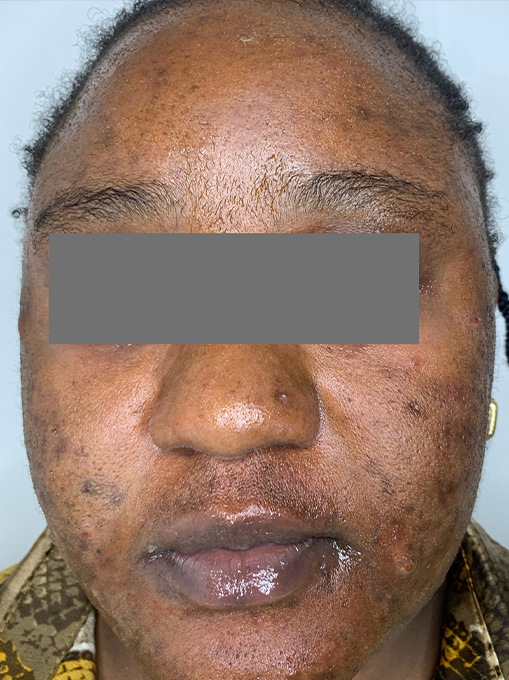 Skin Resurgacing Before and After | Flawless Aesthetic Center