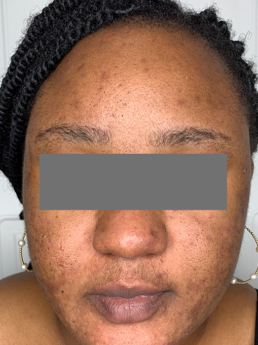 Skin Resurgacing Before and After | Flawless Aesthetic Center