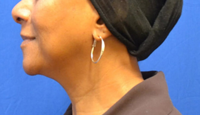 Thermineck And Thermilift Before and After | Flawless Aesthetic Center