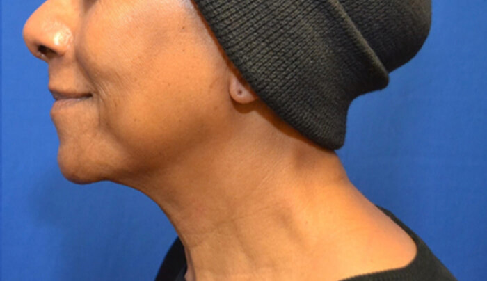 Thermineck And Thermilift Before and After | Flawless Aesthetic Center