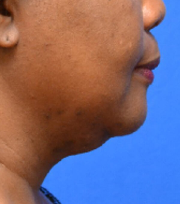 Thermineck And Thermilift Before and After | Flawless Aesthetic Center