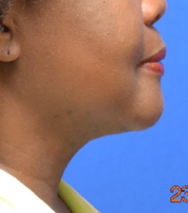 Thermineck And Thermilift Before and After | Flawless Aesthetic Center