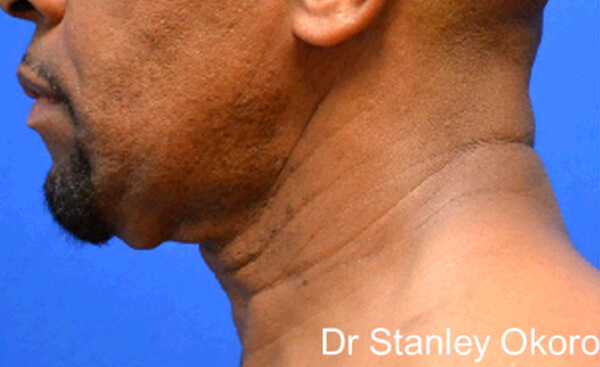 Thermineck And Thermilift Before and After | Flawless Aesthetic Center