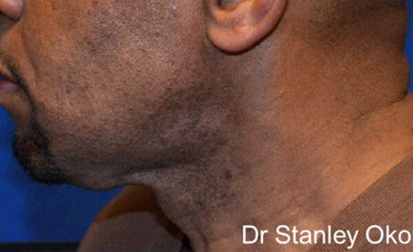 Thermineck And Thermilift Before and After | Flawless Aesthetic Center