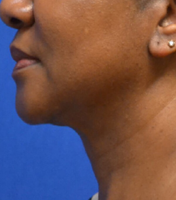 Thermineck And Thermilift Before and After | Flawless Aesthetic Center
