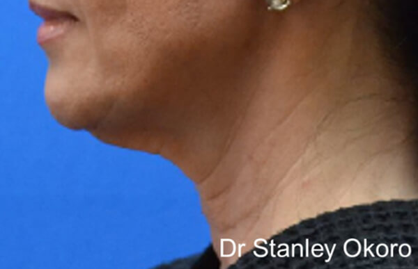 Thermineck And Thermilift Before and After | Flawless Aesthetic Center