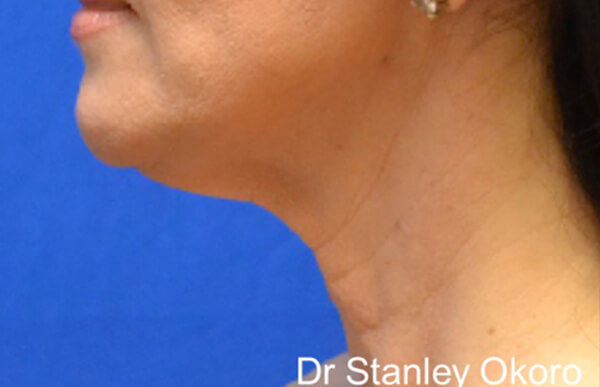 Thermineck And Thermilift Before and After | Flawless Aesthetic Center
