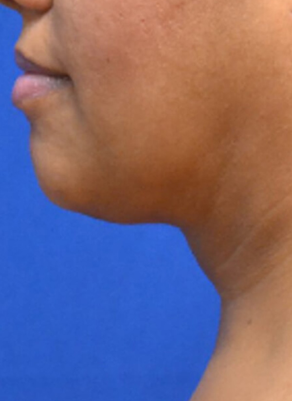 Thermineck And Thermilift Before and After | Flawless Aesthetic Center
