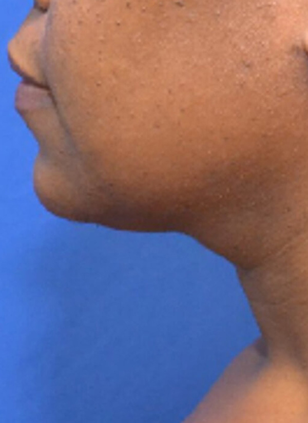 Thermineck And Thermilift Before and After | Flawless Aesthetic Center