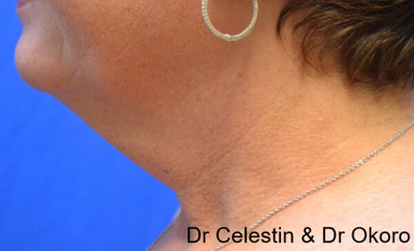 Thermineck And Thermilift Before and After | Flawless Aesthetic Center