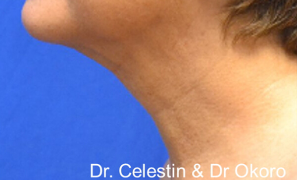 Thermineck And Thermilift Before and After | Flawless Aesthetic Center
