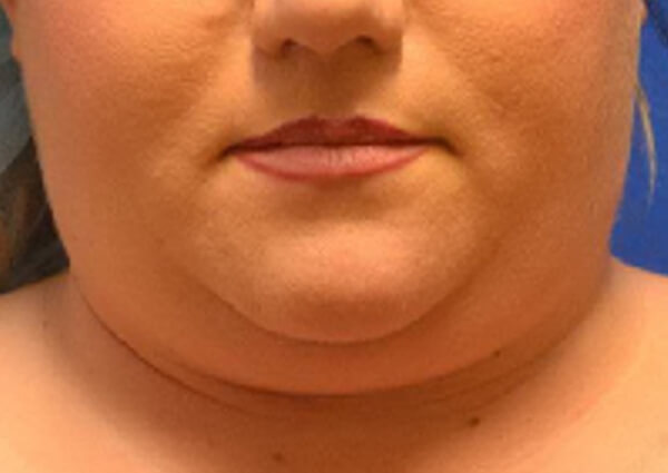 Thermineck And Thermilift Before and After | Flawless Aesthetic Center