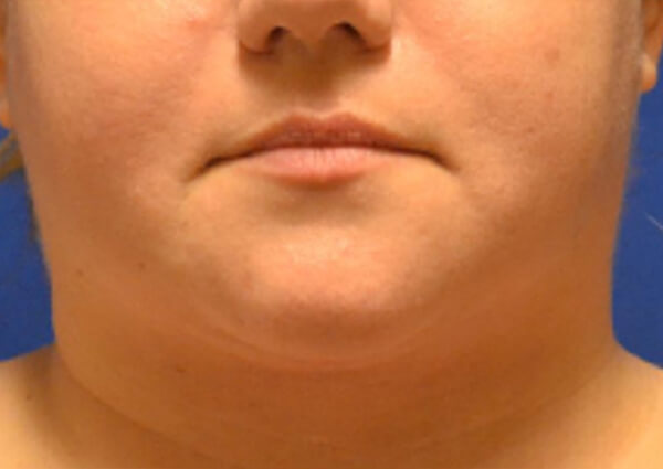 Thermineck And Thermilift Before and After | Flawless Aesthetic Center