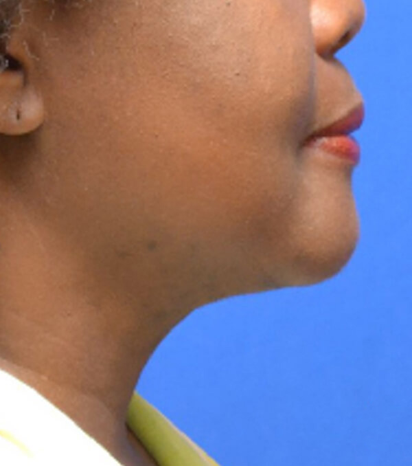 Thermineck And Thermilift Before and After | Flawless Aesthetic Center