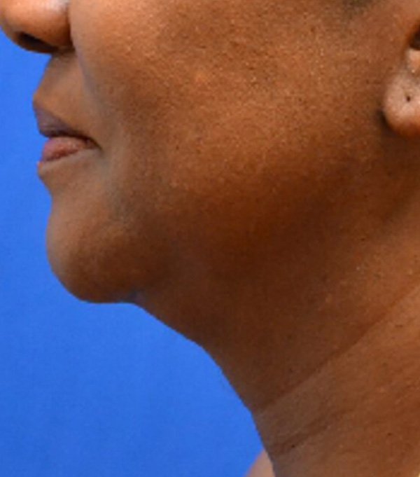 Thermineck And Thermilift Before and After | Flawless Aesthetic Center