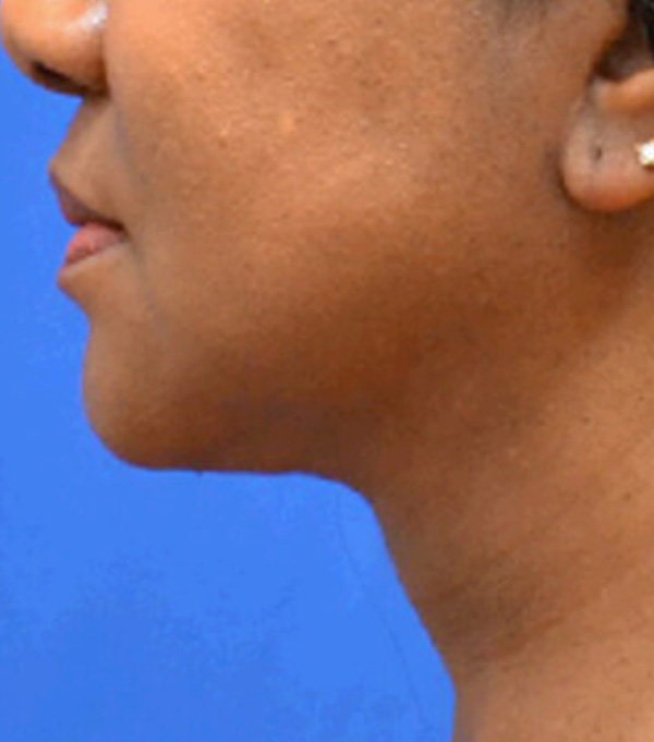 Thermineck And Thermilift Before and After | Flawless Aesthetic Center