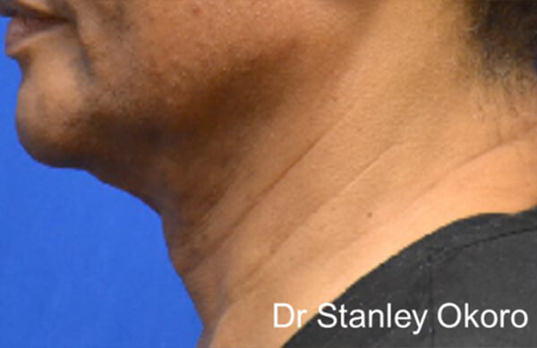 Thermineck And Thermilift Before and After | Flawless Aesthetic Center