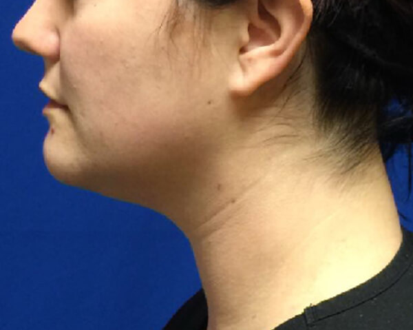 Thermineck And Thermilift Before and After | Flawless Aesthetic Center