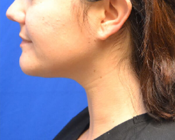 Thermineck And Thermilift Before and After | Flawless Aesthetic Center