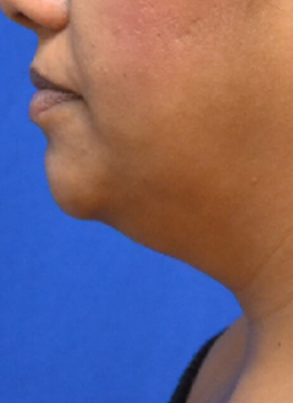 Thermineck And Thermilift Before and After | Flawless Aesthetic Center