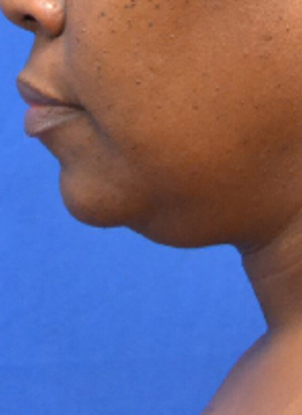Thermineck And Thermilift Before and After | Flawless Aesthetic Center